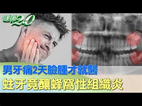 牙痛臉腫怎麼消|牙痛臉會腫嗎？